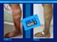 Slider image (8) The Vein Center India